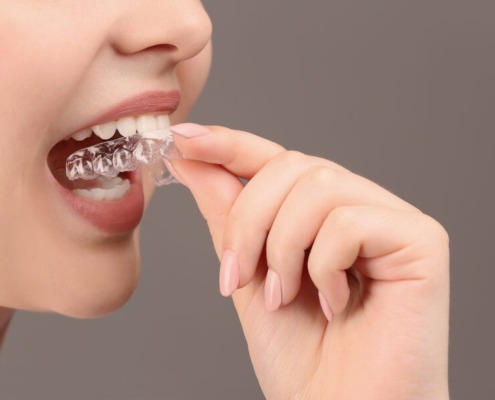 A close up of a person's mouth putting in a clear occlusal mouth guard up against a brown background.