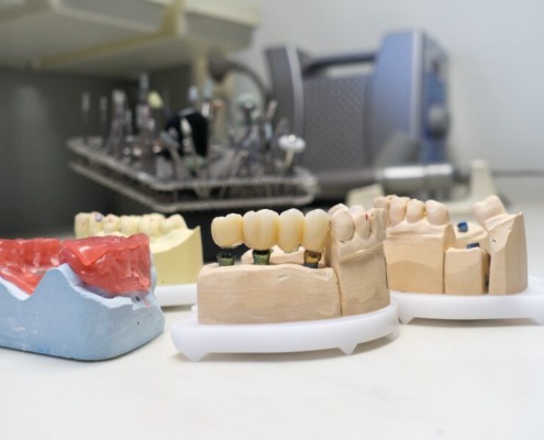 Image of zirconia dental crowns on dental models in the dental laboratory.