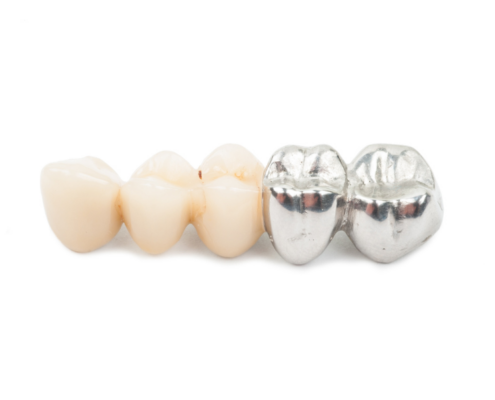 A photo of 3 ceramic crowns next to 2 metal crowns.