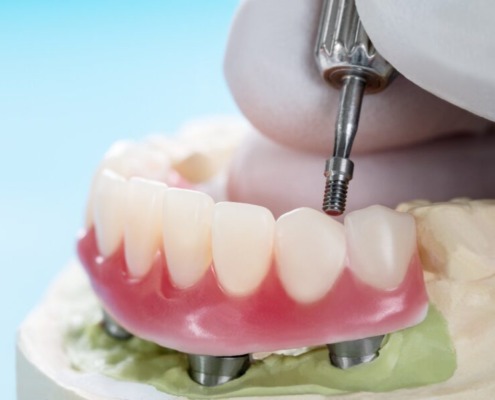 Closeup/dental implants supported overdenture on blue background.