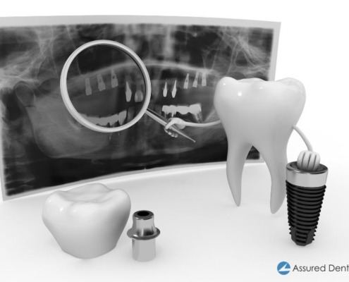 3D image of a cartoon tooth holding a magnifying glass up to an x-ray of teeth.