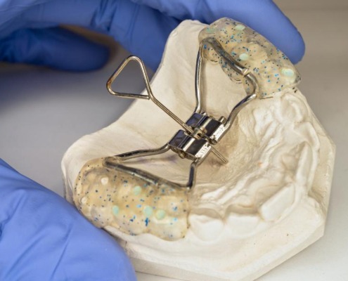 Close up of teeth expander on a mold of a teeth, held by a blue, gloved hand.