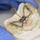 Close up of teeth expander on a mold of a teeth, held by a blue, gloved hand.